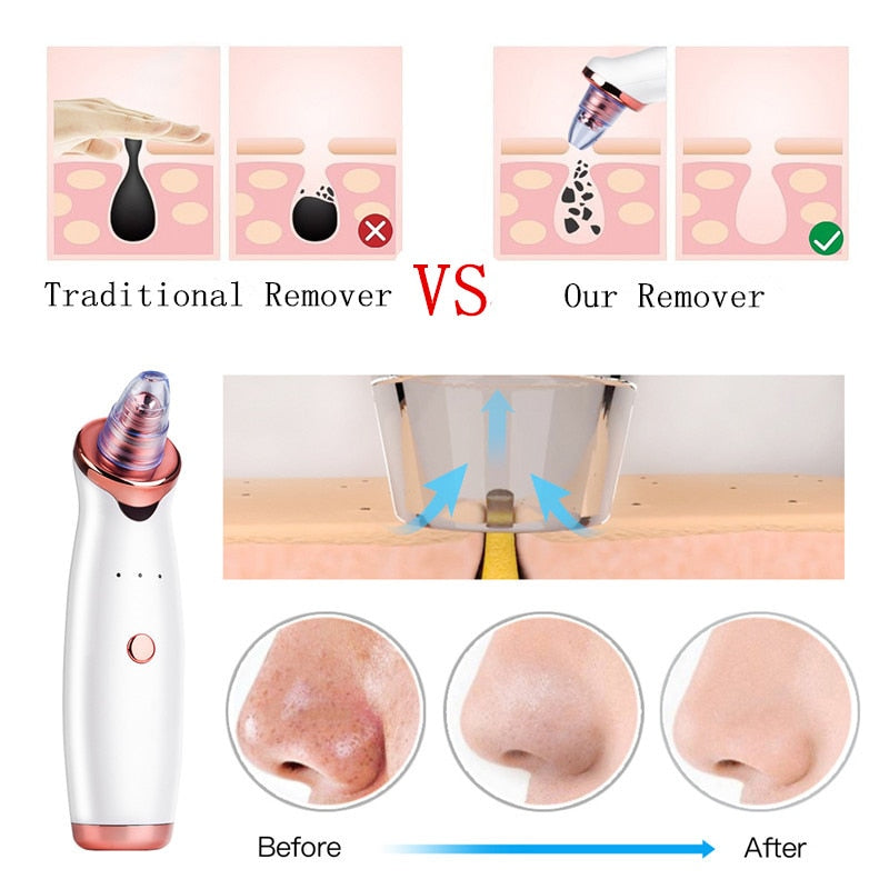 Electric Blackhead Remover Vacuum